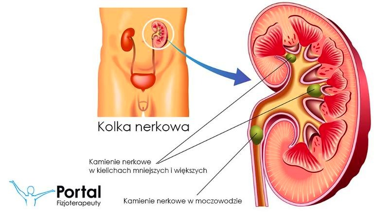 Jakie leki na kamienie nerkowe? Co pomaga na ból i kolkę nerkową
