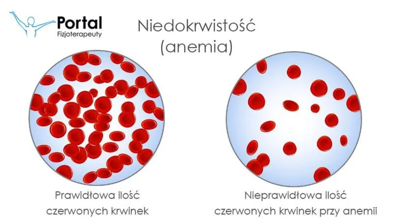 Niska hemoglobina – co oznacza wynik i jak ustalić przyczynę?
