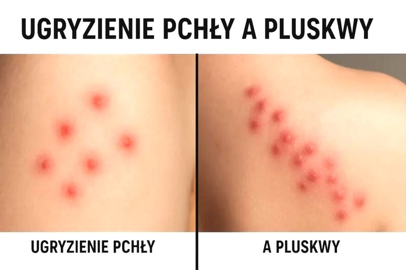 Ugryzienia pluskiew – jak rozpoznać i złagodzić objawy