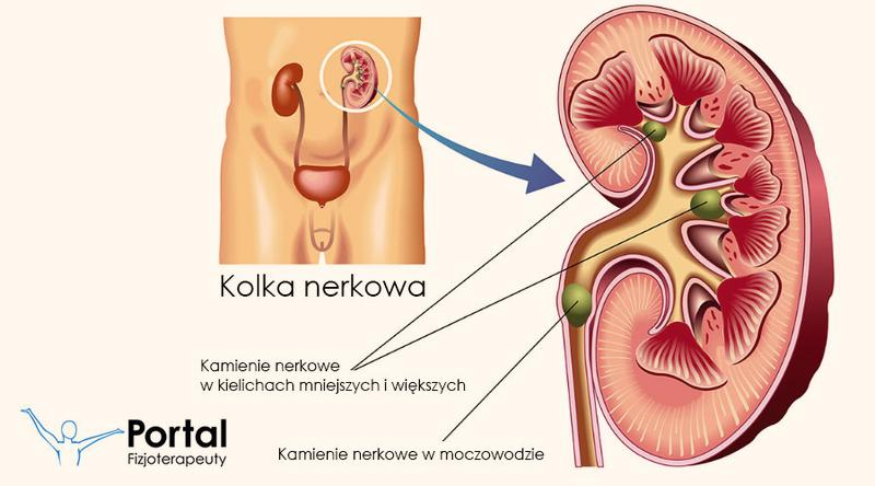 Ból i kolka nerkowa