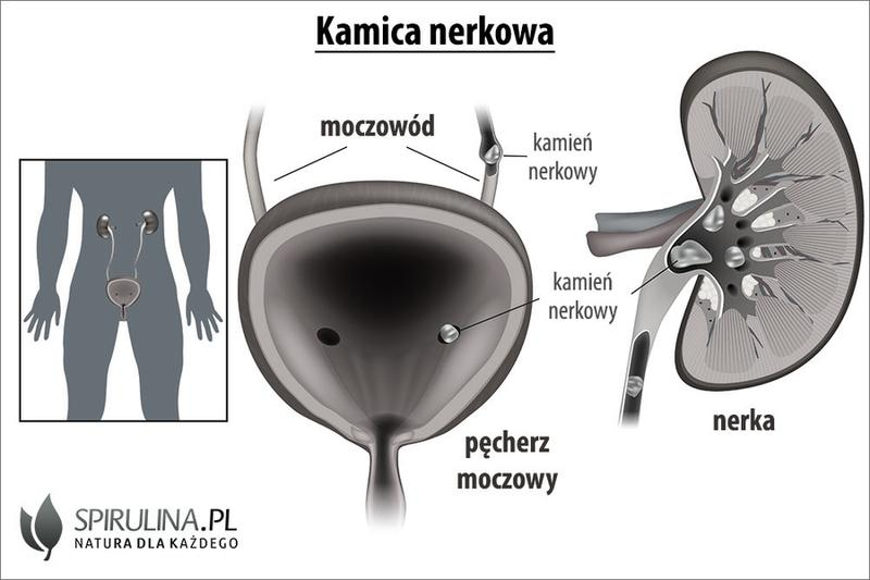 Kamienie nerkowe