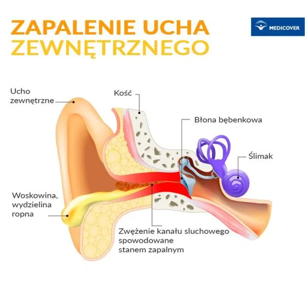Leki na zapalenie ucha