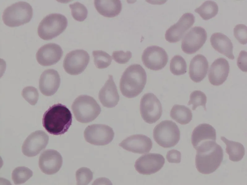 Niska hemoglobina