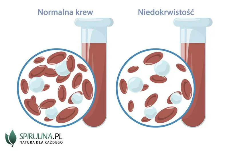 Objawy niedokrwistości