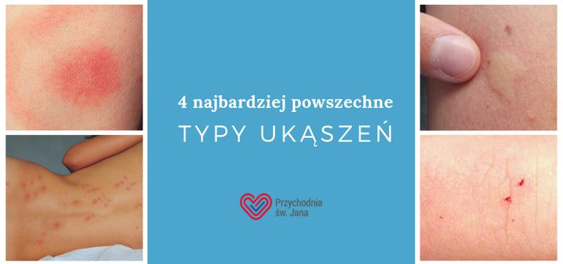 Ugryzienie pająka